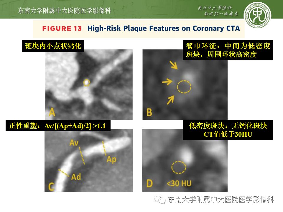 【病例】冠脉CTA一例—冠脉疾病报告和数据系统