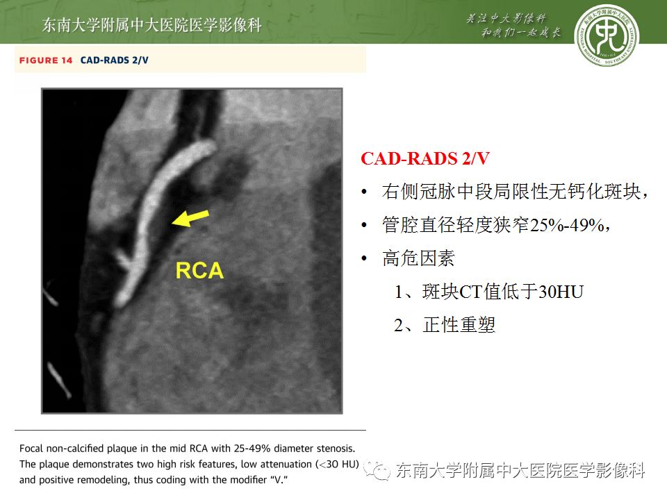 【病例】冠脉CTA一例—冠脉疾病报告和数据系统