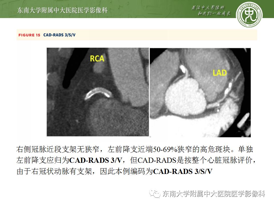 【病例】冠脉CTA一例—冠脉疾病报告和数据系统