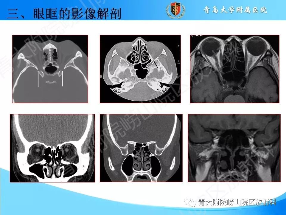 【PPT】眼眶肿瘤的影像诊断