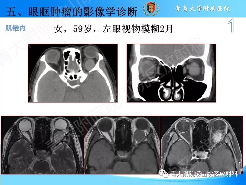 【PPT】眼眶肿瘤的影像诊断