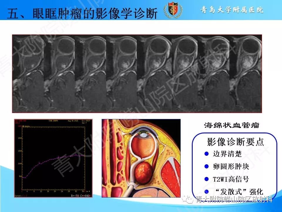 【PPT】眼眶肿瘤的影像诊断