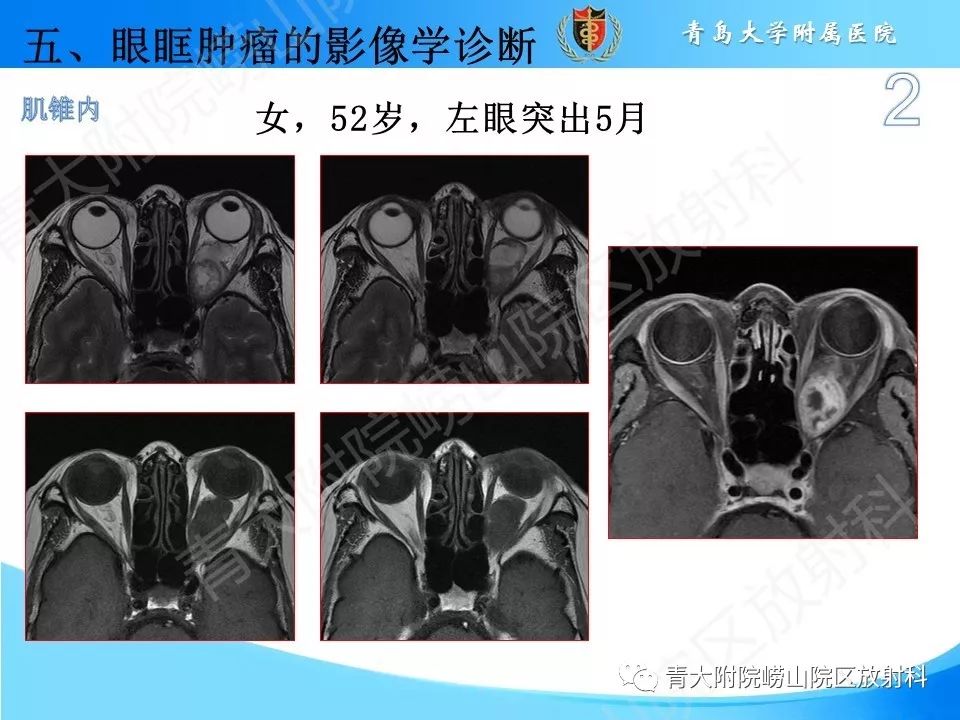 【PPT】眼眶肿瘤的影像诊断