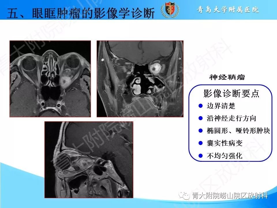【PPT】眼眶肿瘤的影像诊断