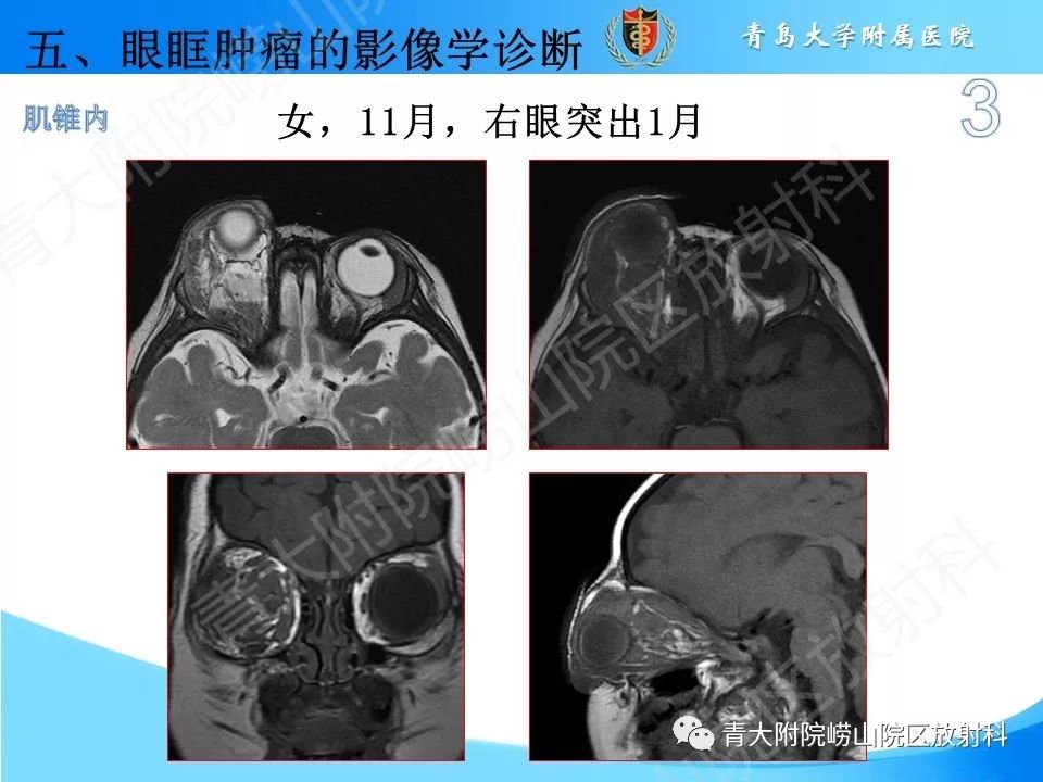 【PPT】眼眶肿瘤的影像诊断