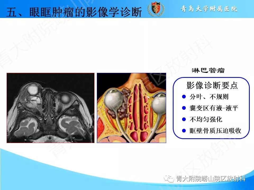 【PPT】眼眶肿瘤的影像诊断