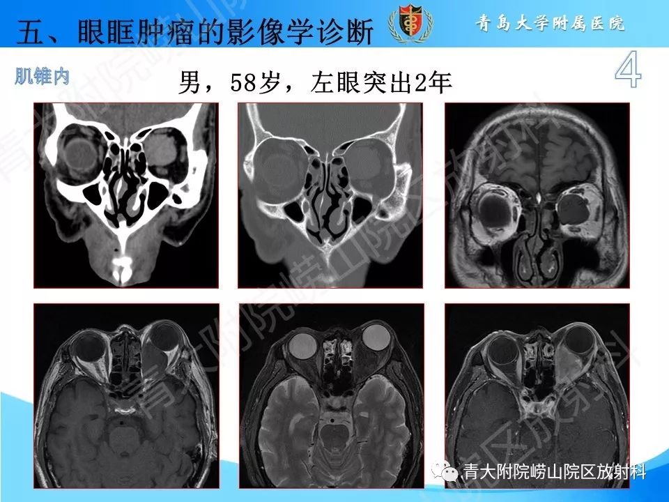 【PPT】眼眶肿瘤的影像诊断