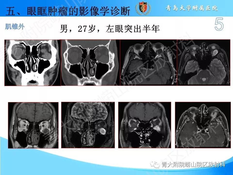 【PPT】眼眶肿瘤的影像诊断