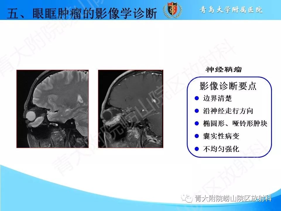 【PPT】眼眶肿瘤的影像诊断