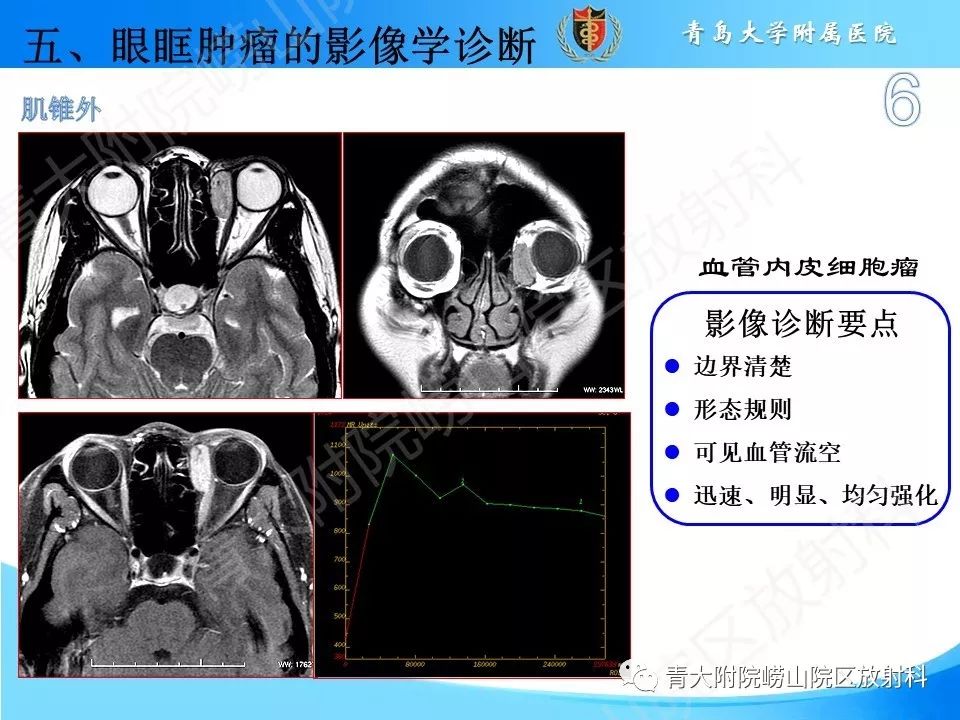 【PPT】眼眶肿瘤的影像诊断