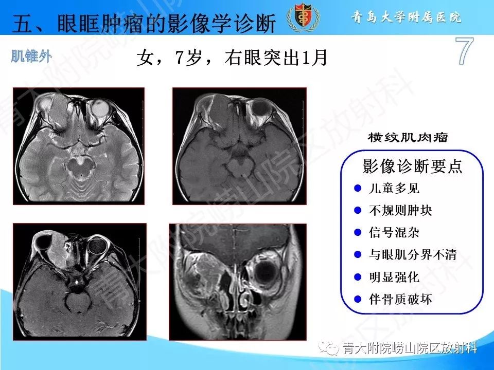 【PPT】眼眶肿瘤的影像诊断
