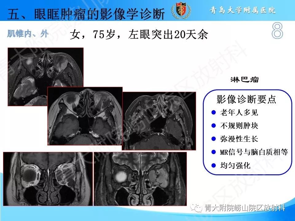 【PPT】眼眶肿瘤的影像诊断
