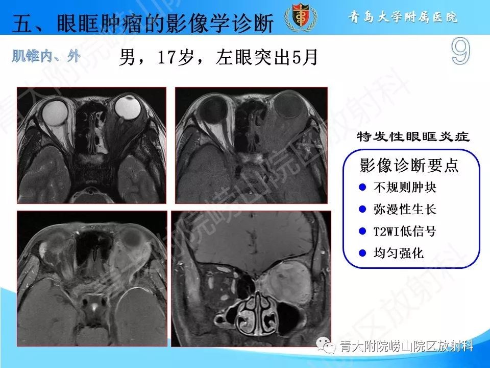 【PPT】眼眶肿瘤的影像诊断