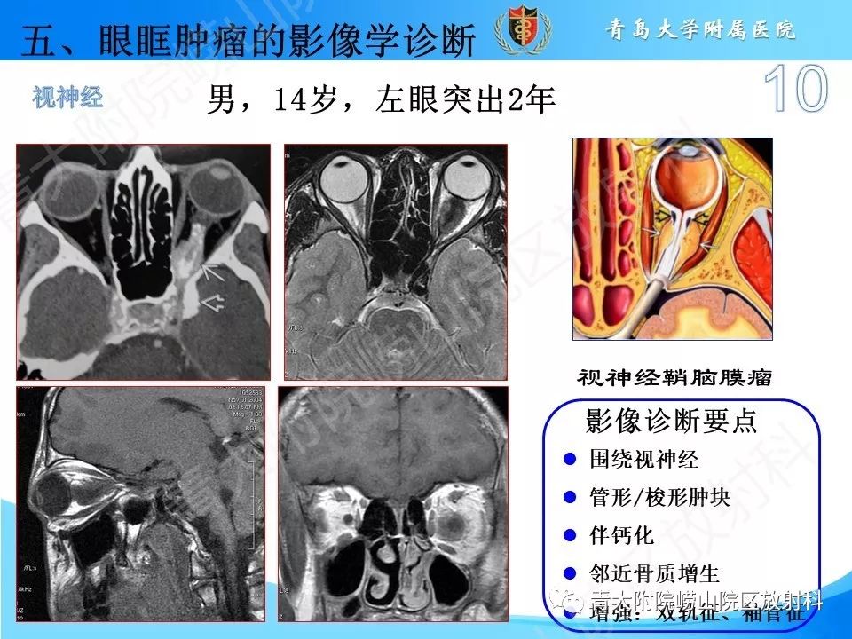 【PPT】眼眶肿瘤的影像诊断