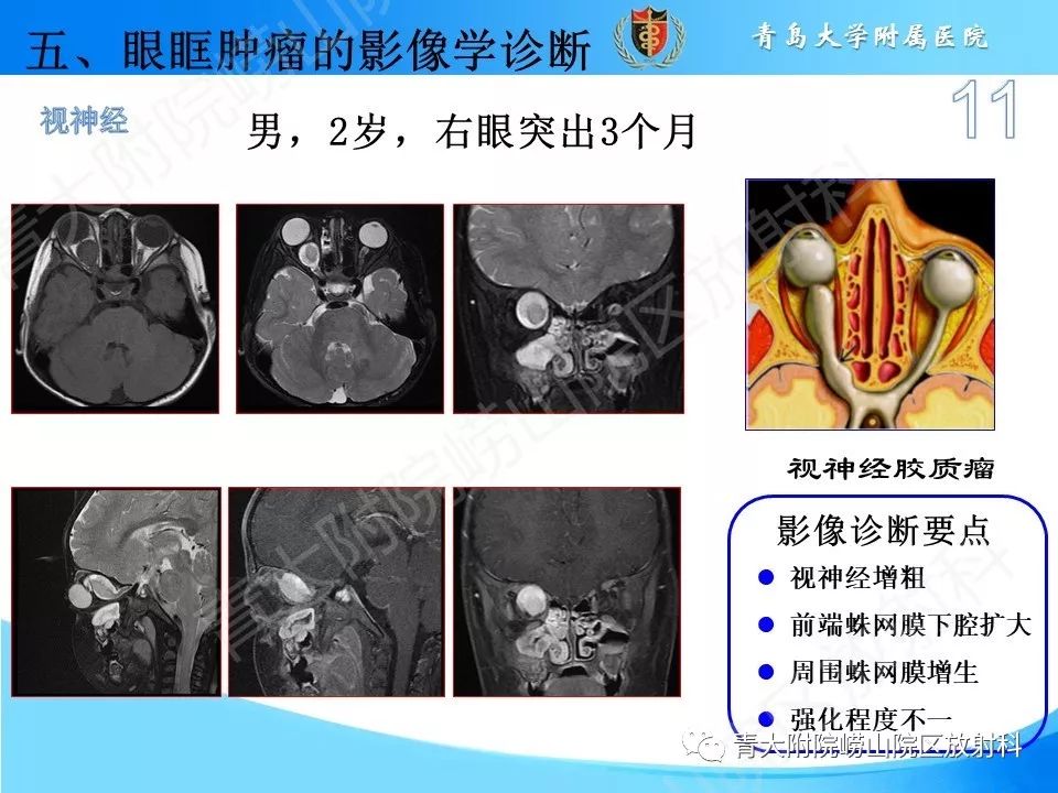 【PPT】眼眶肿瘤的影像诊断