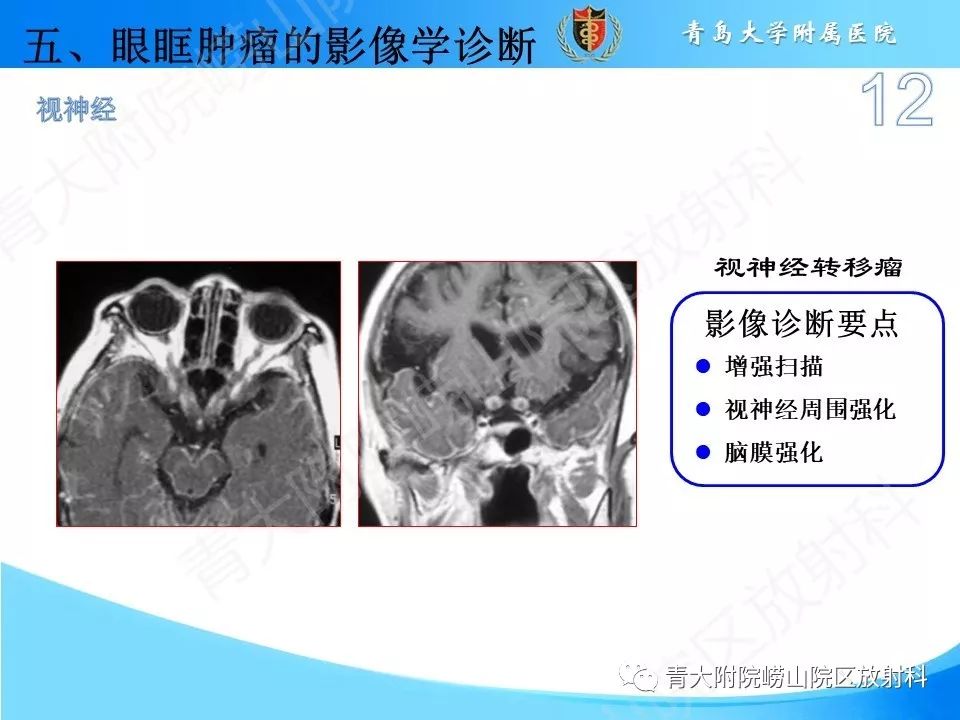 【PPT】眼眶肿瘤的影像诊断
