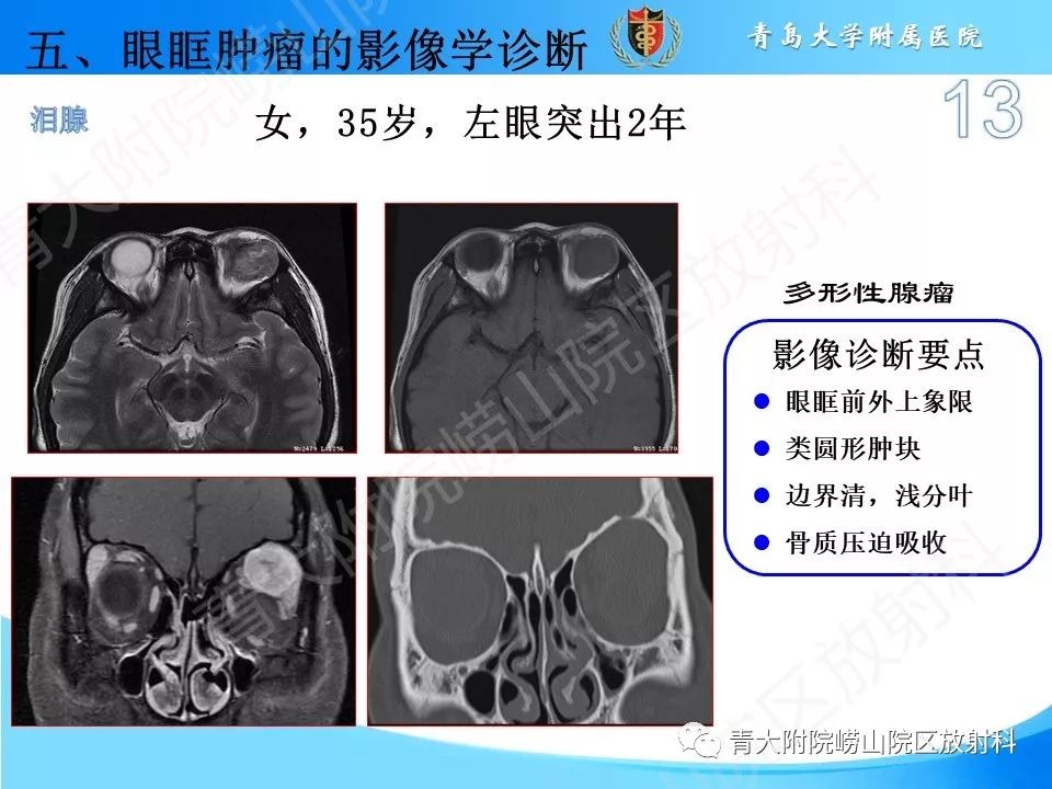【PPT】眼眶肿瘤的影像诊断