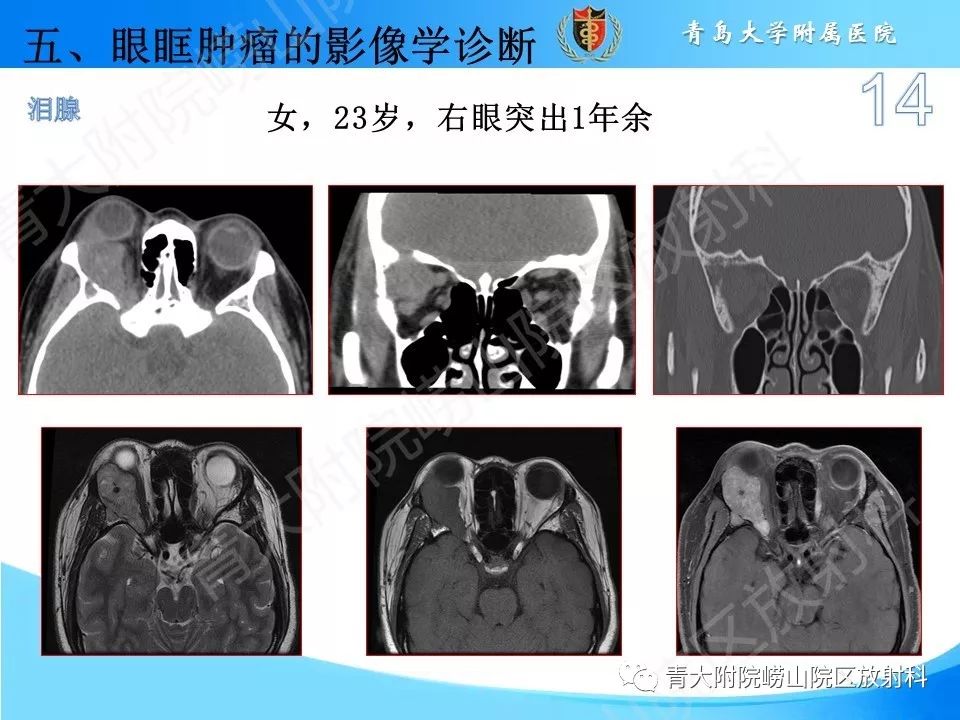 【PPT】眼眶肿瘤的影像诊断