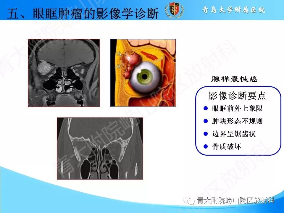【PPT】眼眶肿瘤的影像诊断