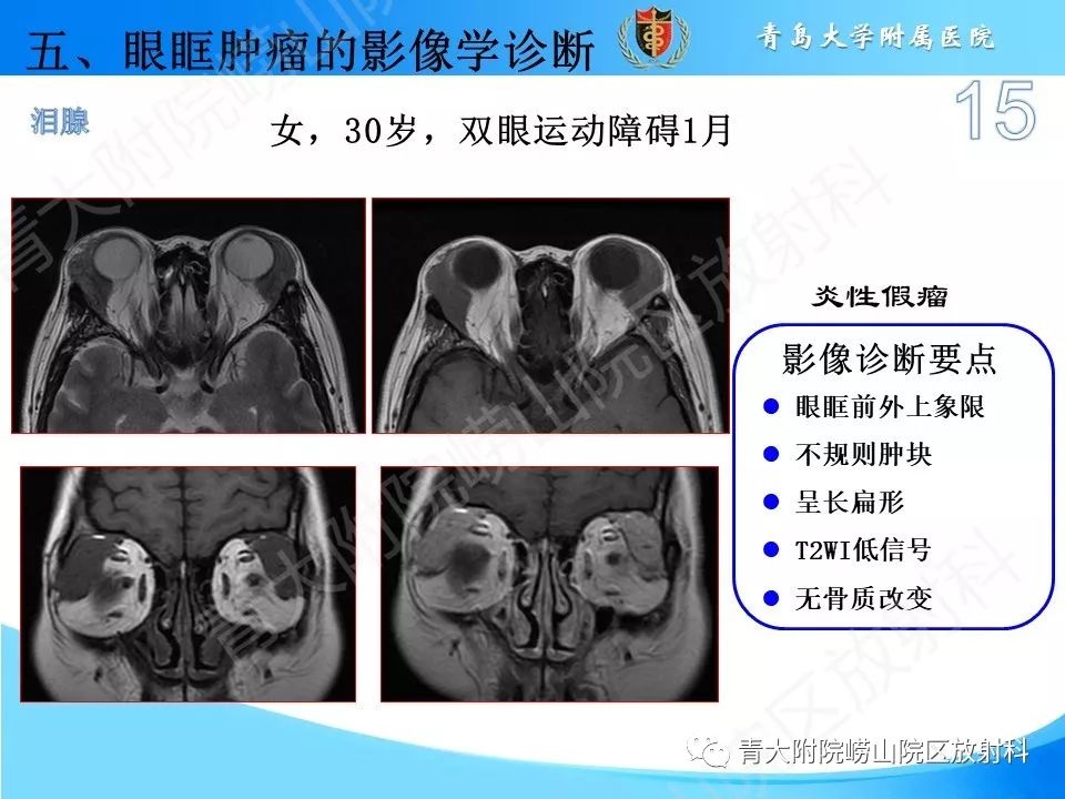【PPT】眼眶肿瘤的影像诊断