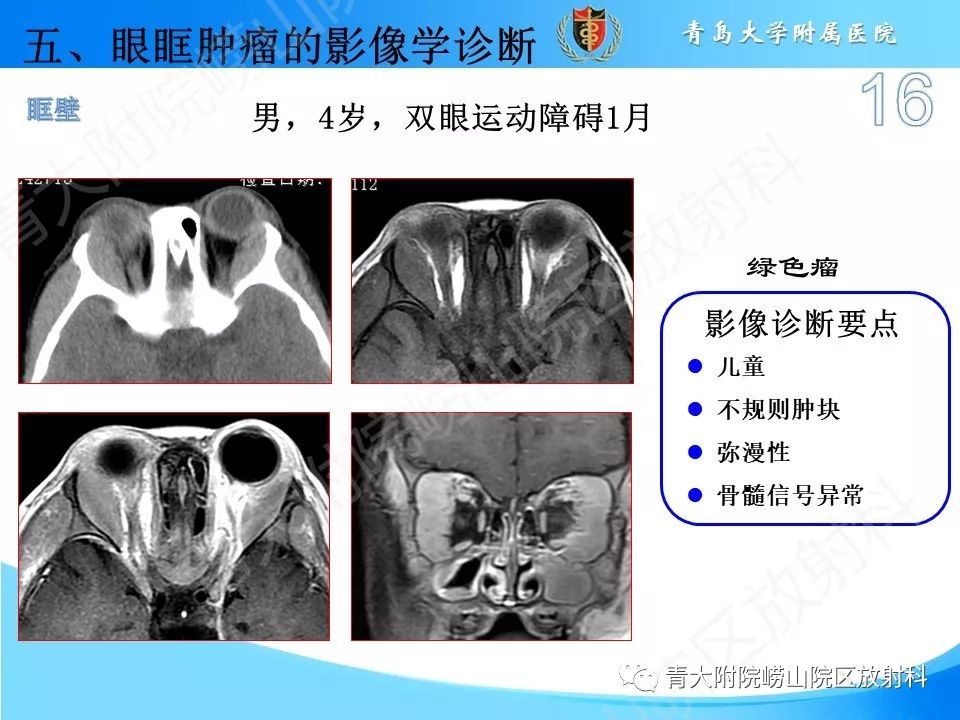 【PPT】眼眶肿瘤的影像诊断