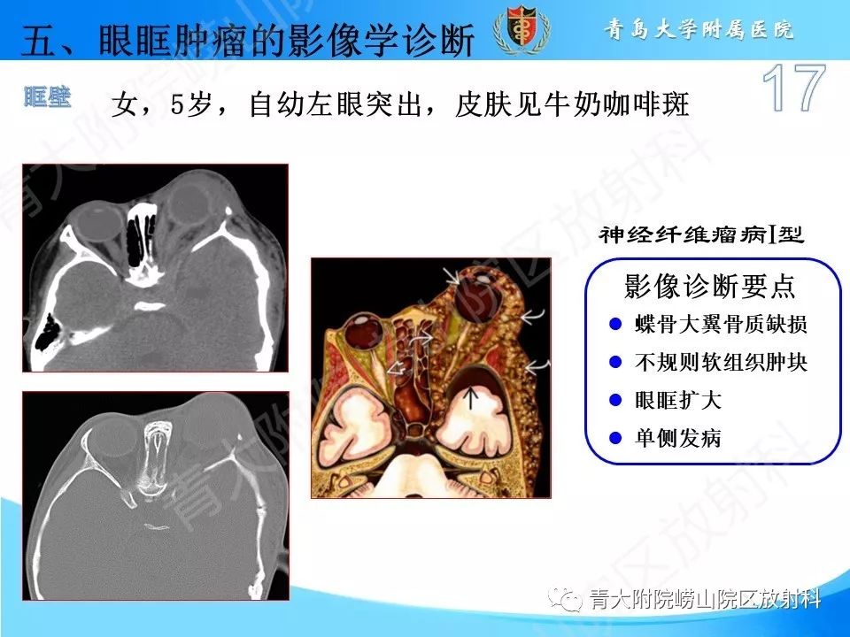 【PPT】眼眶肿瘤的影像诊断