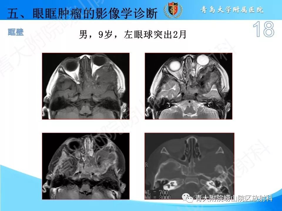 【PPT】眼眶肿瘤的影像诊断