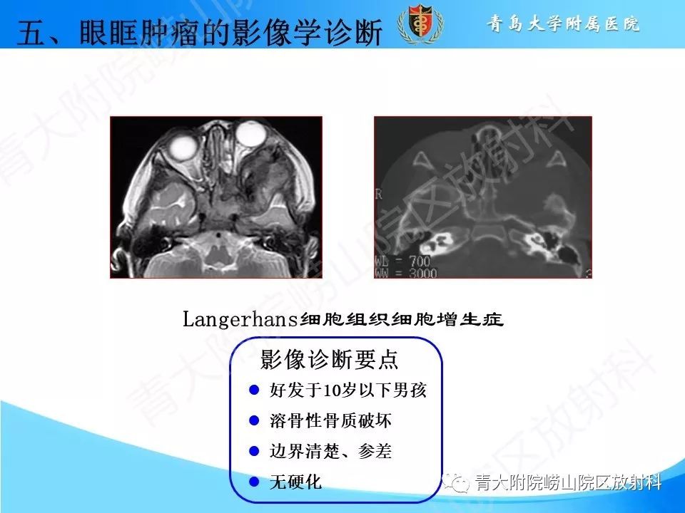 【PPT】眼眶肿瘤的影像诊断