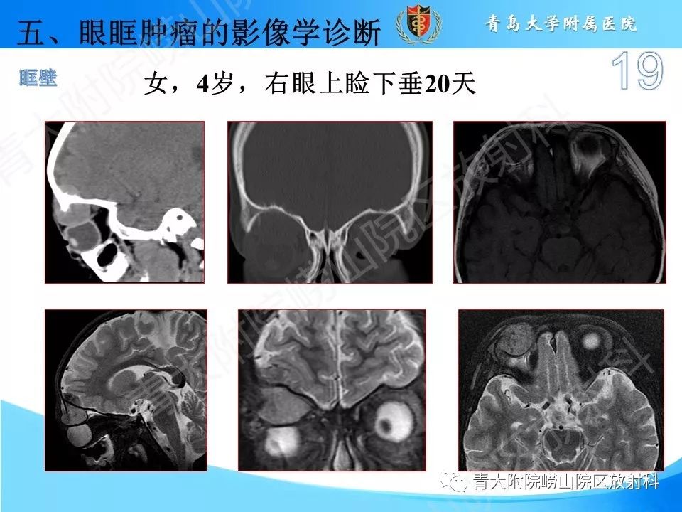【PPT】眼眶肿瘤的影像诊断