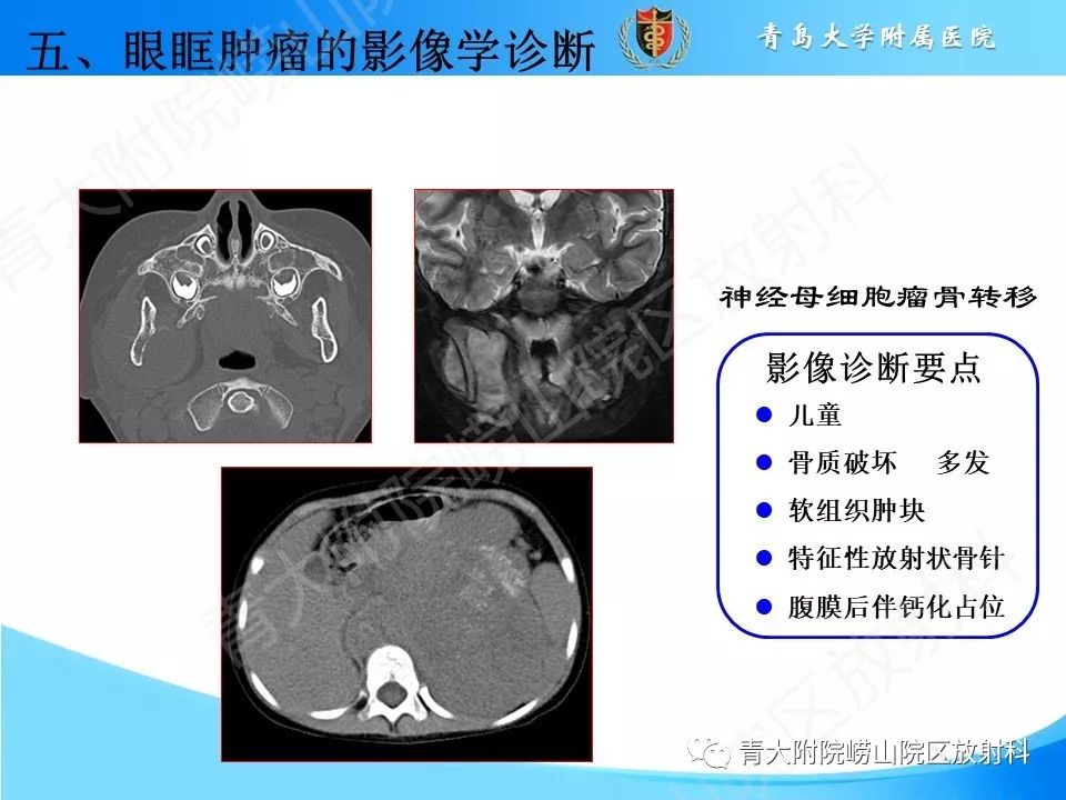 【PPT】眼眶肿瘤的影像诊断