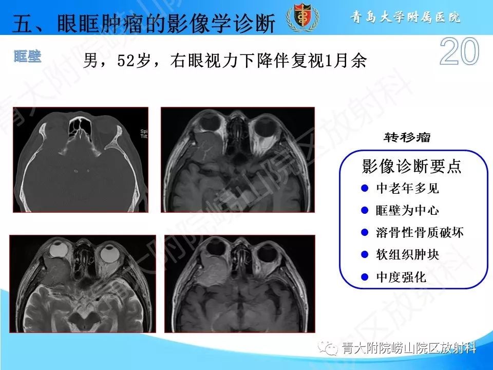 【PPT】眼眶肿瘤的影像诊断