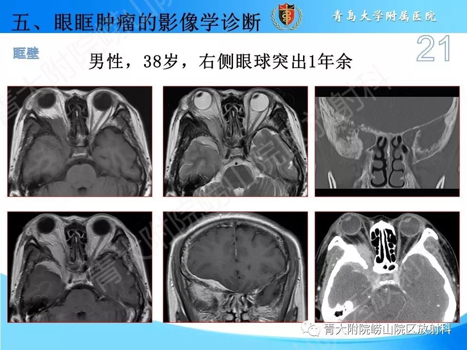 【PPT】眼眶肿瘤的影像诊断