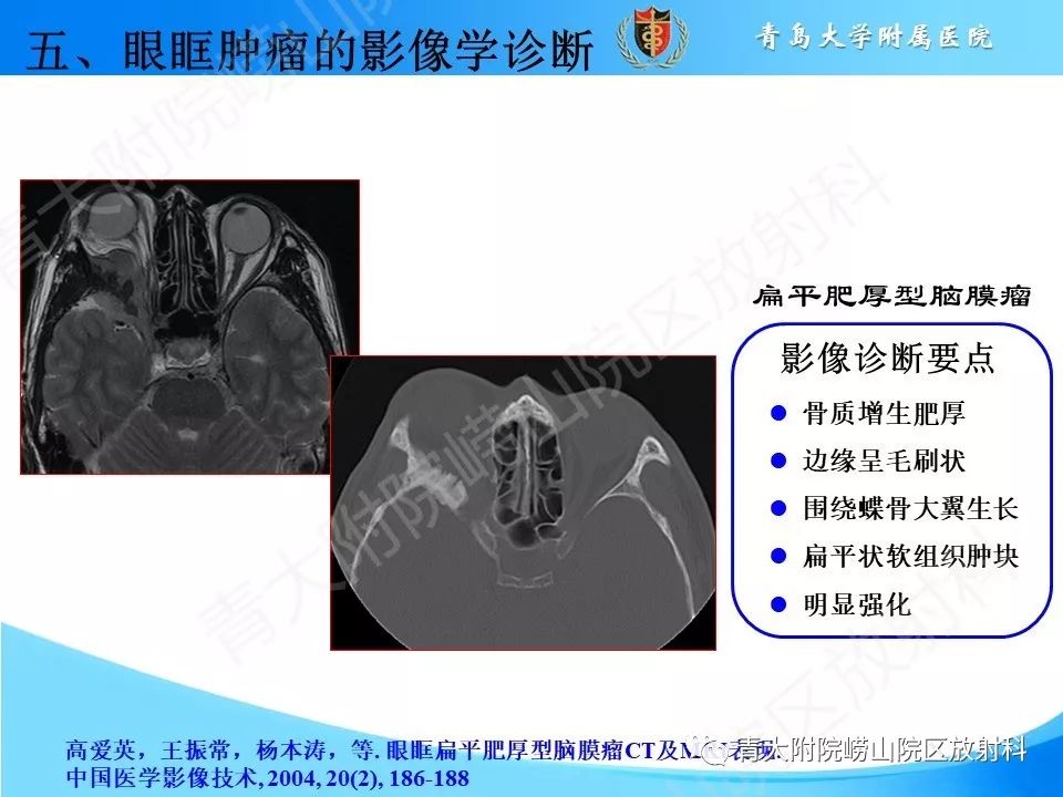【PPT】眼眶肿瘤的影像诊断