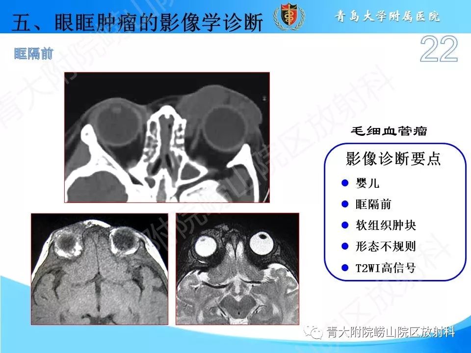 【PPT】眼眶肿瘤的影像诊断