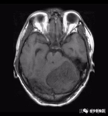 【病例】小脑发育不良性神经节细胞瘤1例MR