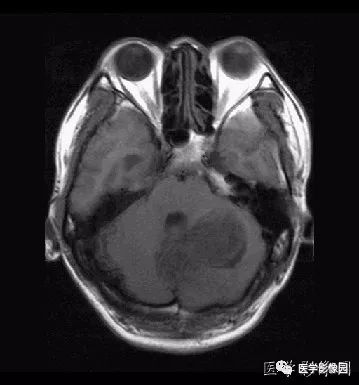 【病例】小脑发育不良性神经节细胞瘤1例MR