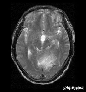 【病例】小脑发育不良性神经节细胞瘤1例MR