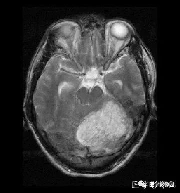 【病例】小脑发育不良性神经节细胞瘤1例MR