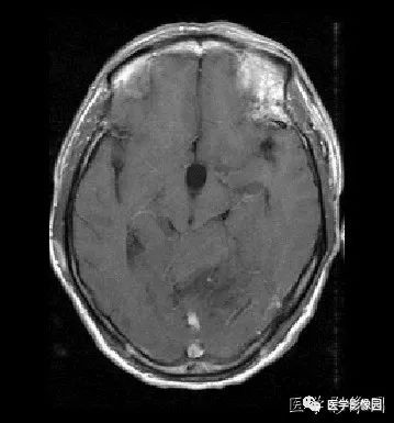 【病例】小脑发育不良性神经节细胞瘤1例MR