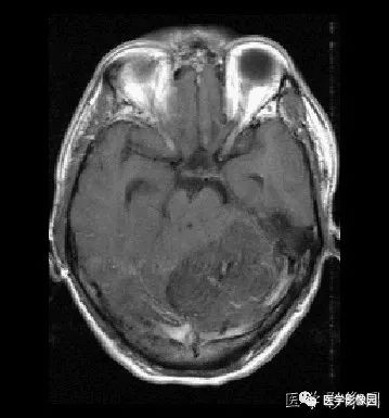 【病例】小脑发育不良性神经节细胞瘤1例MR