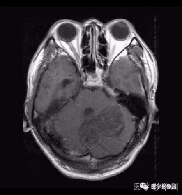 【病例】小脑发育不良性神经节细胞瘤1例MR