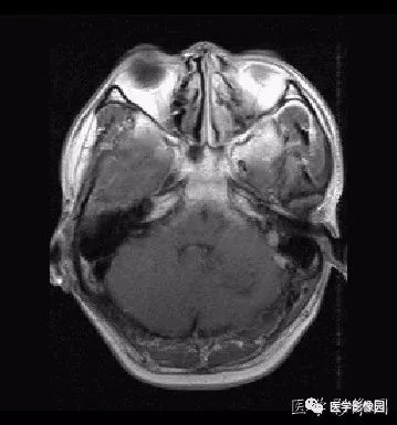 【病例】小脑发育不良性神经节细胞瘤1例MR