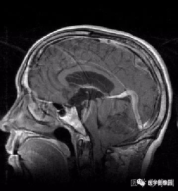 【病例】小脑发育不良性神经节细胞瘤1例MR