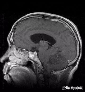 【病例】小脑发育不良性神经节细胞瘤1例MR