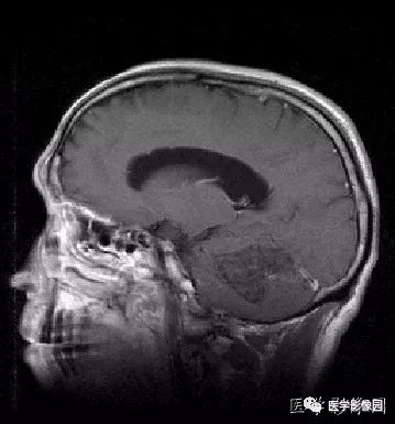 【病例】小脑发育不良性神经节细胞瘤1例MR