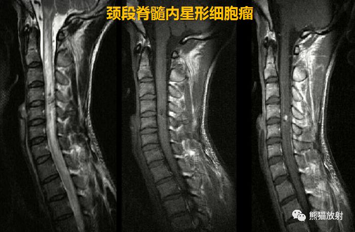 【病例】髓内神经鞘瘤1例MR