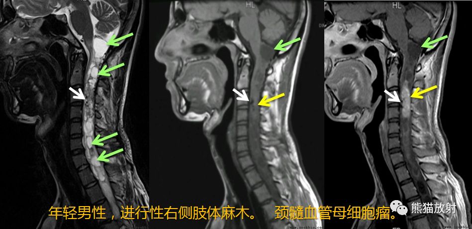 【病例】髓内神经鞘瘤1例MR