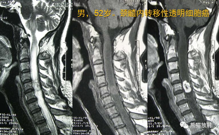 【病例】髓内神经鞘瘤1例MR