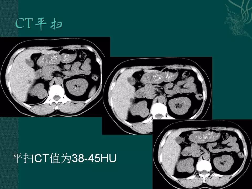 【病例】后肾腺瘤1例CT影像表现 【病例】后肾腺瘤1例CT影像表现