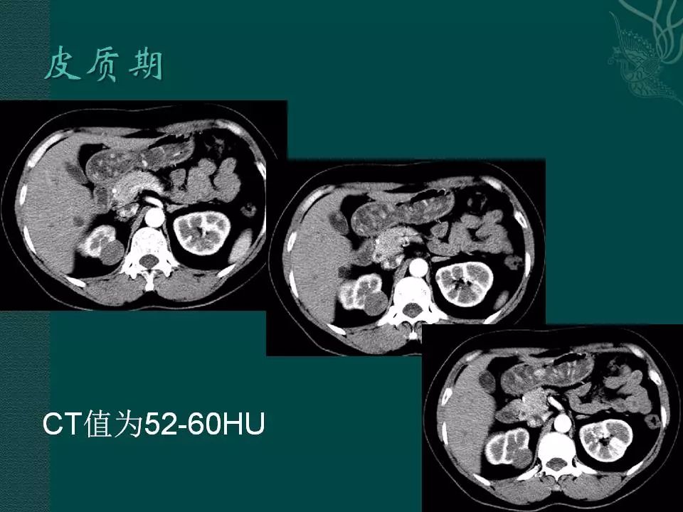 【病例】后肾腺瘤1例CT影像表现 【病例】后肾腺瘤1例CT影像表现